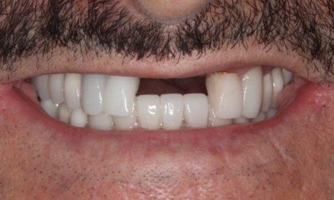 Smile Makeovers in Lafayette | Before & After