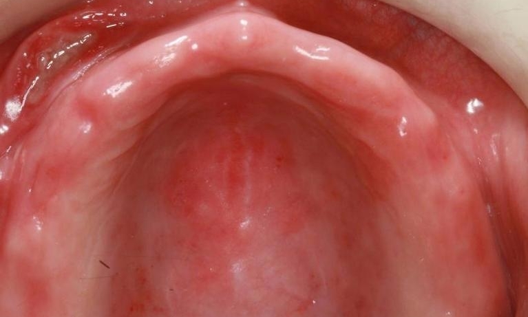 Dentures-Before-Image