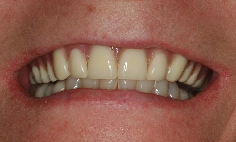 Fixed-Permanent-Implant-Bridge-Before-Image