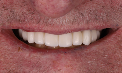 Tooth Replacement in Lafayette | Before & After