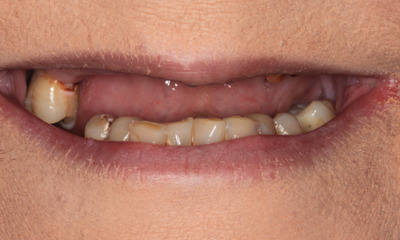 Smile Makeover in Lafayette | Before & After