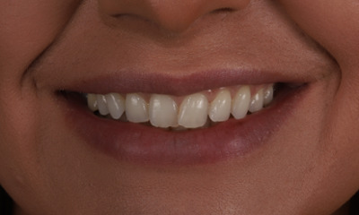Tooth Restorations in Lafayette | Before & After
