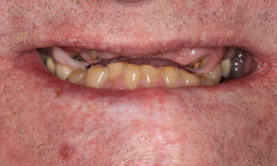 Tooth Replacement in Lafayette | Before & After