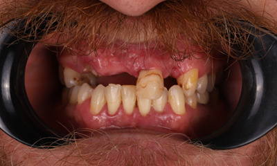 Tooth Replacement in Lafayette | Before & After